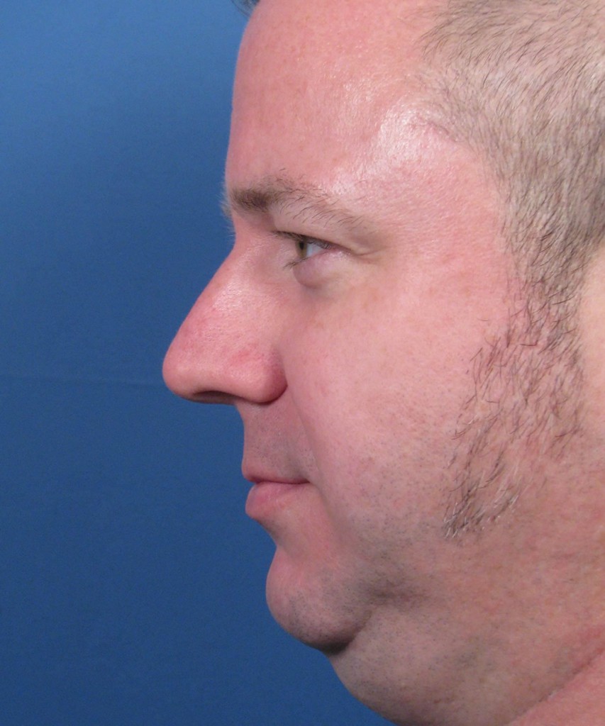 Before lateral