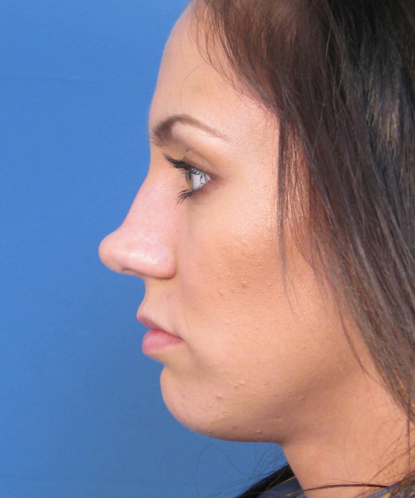 Before side
