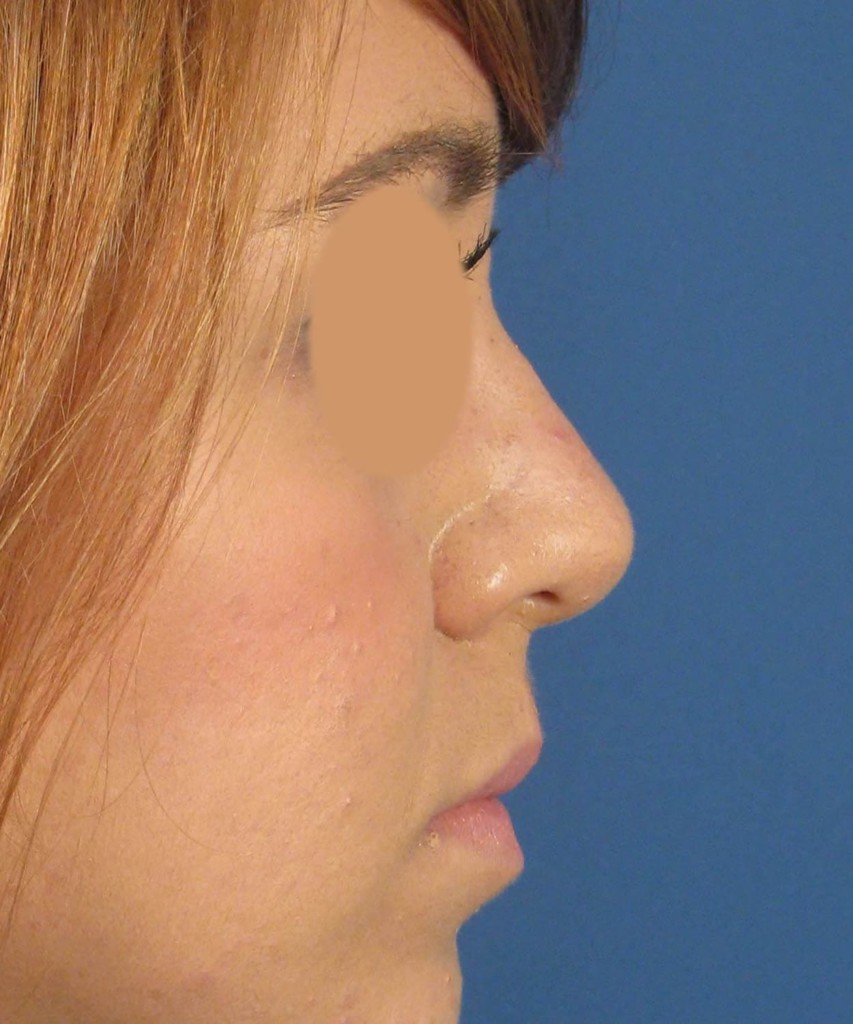After lateral