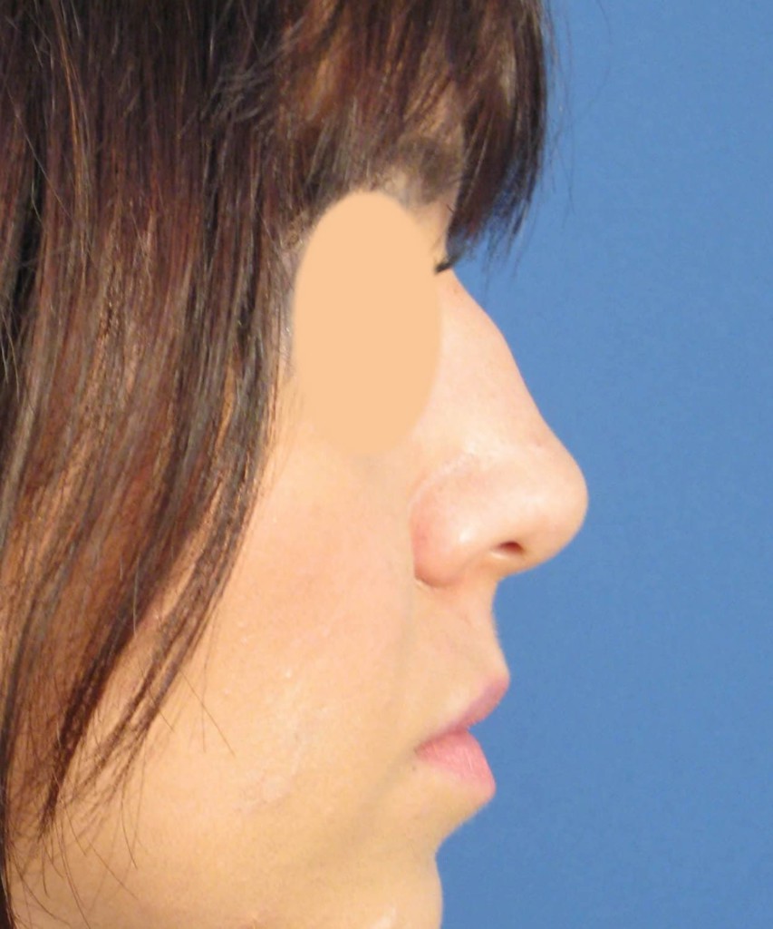 Before lateral