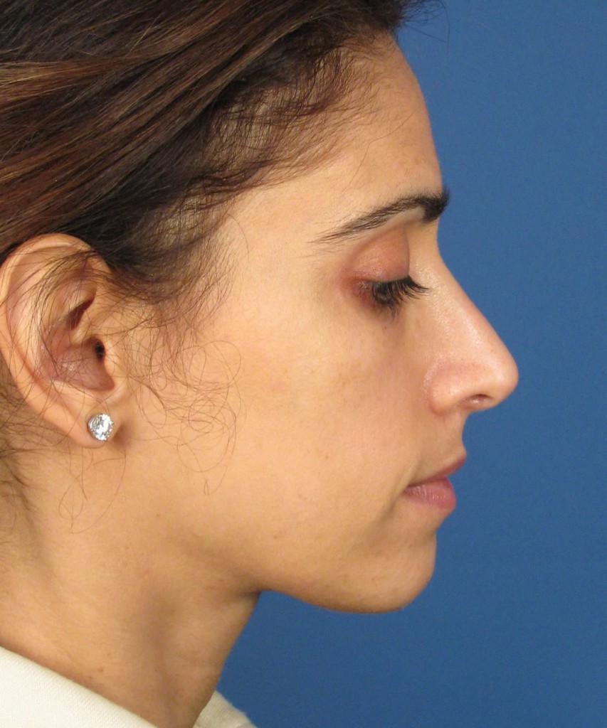 After lateral