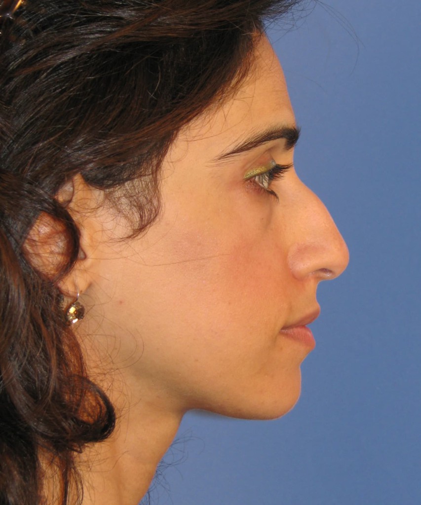 Before lateral