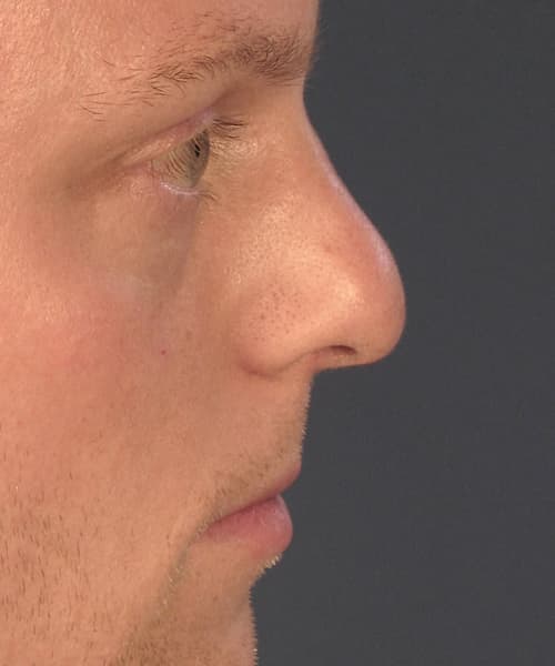 Before side-left