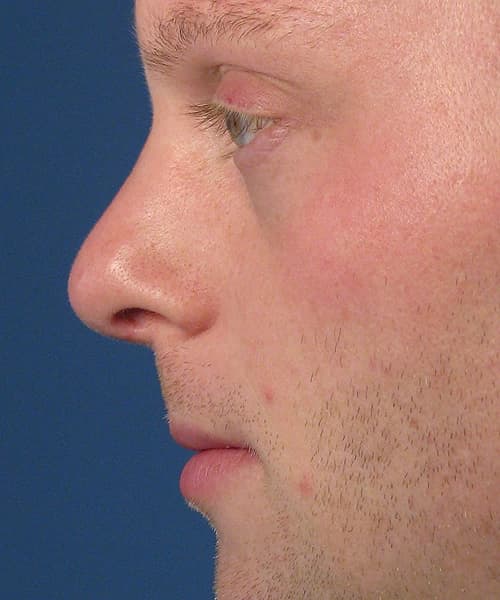 After side-right