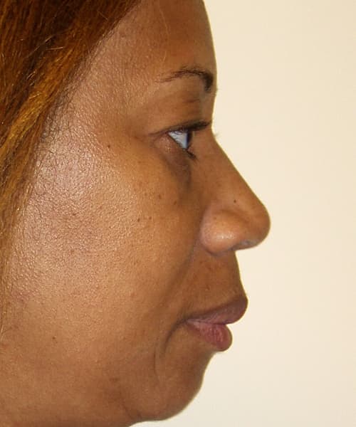 Before side