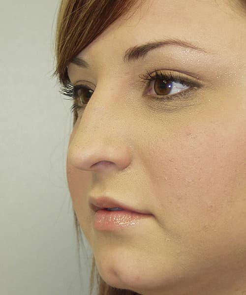 Before angle