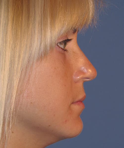 Before side